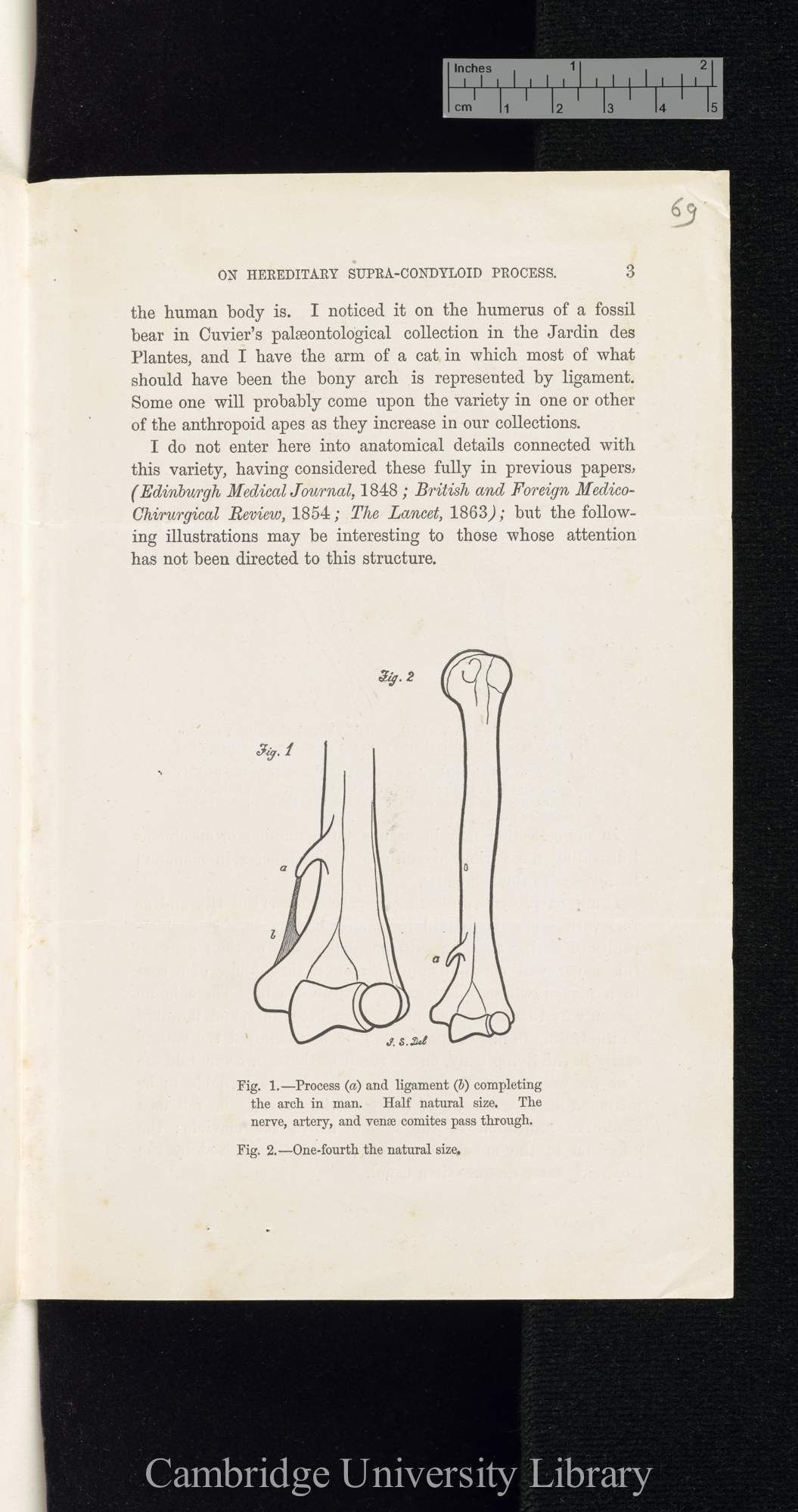 Struthers, John. On hereditary supra-condyloid process in man &#39;[source unknown]&#39;: 1 sheet folded, reset from &#39;Lancet&#39; February 1873: 231-232 [3]