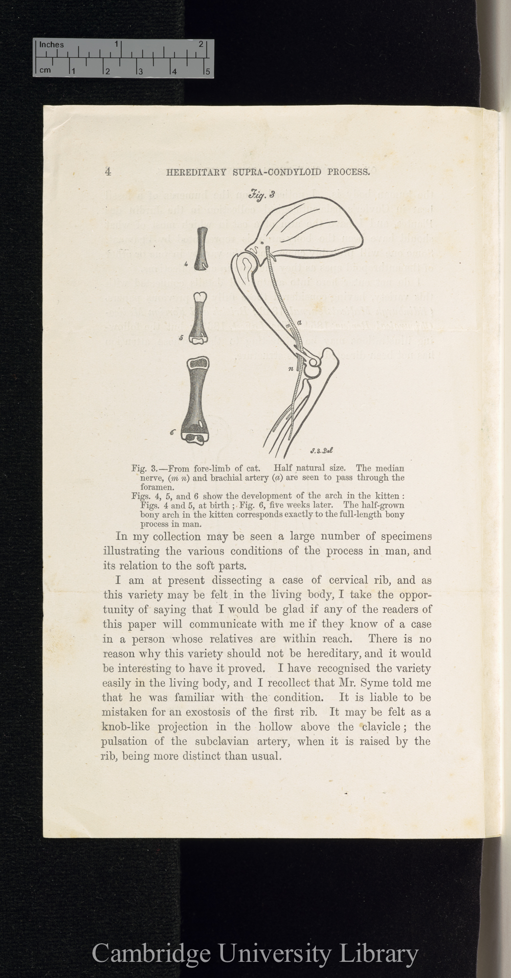 Struthers, John. On hereditary supra-condyloid process in man &#39;[source unknown]&#39;: 1 sheet folded, reset from &#39;Lancet&#39; February 1873: 231-232 [4]